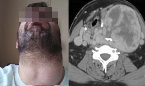 Severely enlarged left thyroid lobe