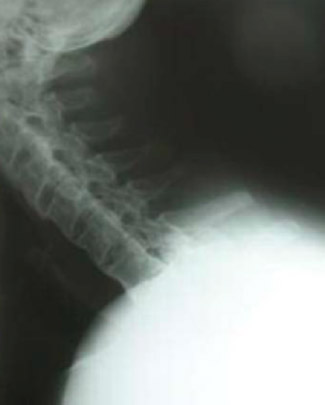 Severe ankylosing spondylitis