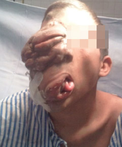 Awake Plexiform neurofibroma of face