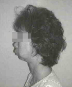 Severe macrosomia. After failed awake nasotracheal FOB