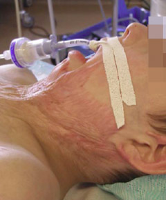 7-year-old child with severe cervical burned sequel