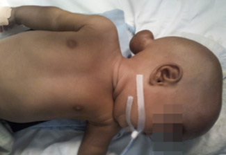 3 month old child with occipital meningocele