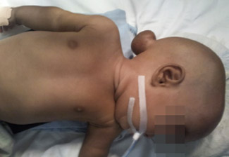 3 month old child with occipital meningocele