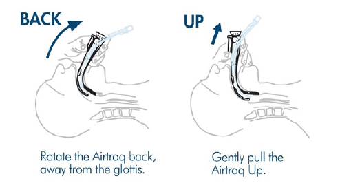 Location of glottic structures