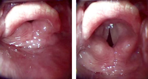 Location of glottic structures