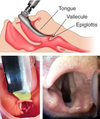 Blade in the Vallecula (preferred)