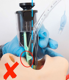 Airtraq tilted against upper teeth
