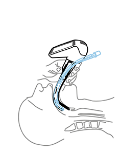 Center vocal cords